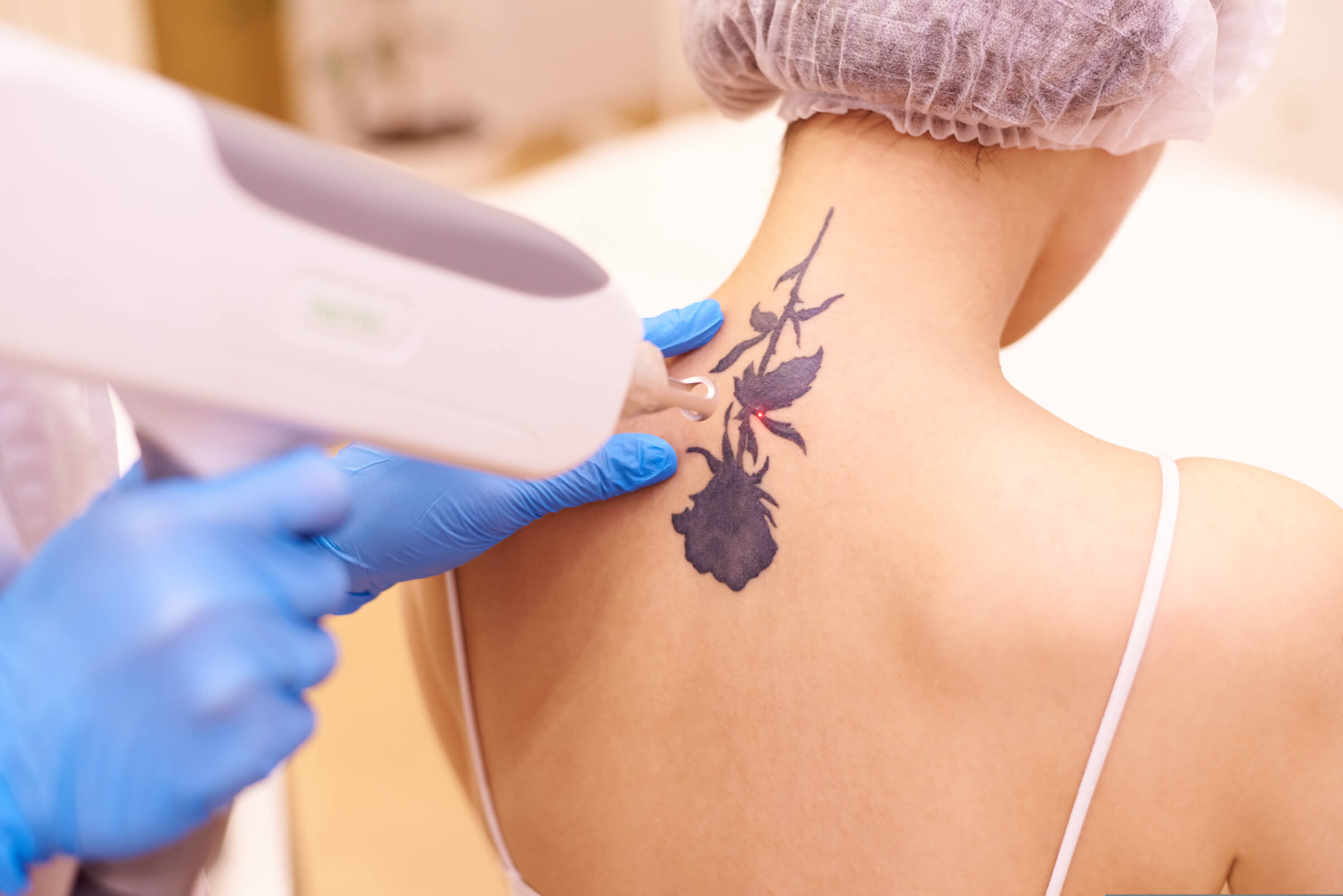 Picosure Tattoo Removal Process - Berman Cosmetic Surgery